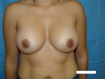 Breast Augmentation After Photo by Moneer Jaibaji, MD; Coronado, CA - Case 20453
