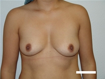 Breast Augmentation Before Photo by Moneer Jaibaji, MD; Coronado, CA - Case 20453