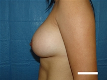 Breast Augmentation After Photo by Moneer Jaibaji, MD; Coronado, CA - Case 20453