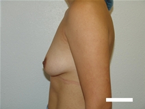 Breast Augmentation Before Photo by Moneer Jaibaji, MD; Coronado, CA - Case 20453