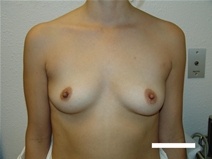 Breast Augmentation Before Photo by Moneer Jaibaji, MD; Coronado, CA - Case 20455