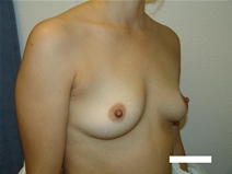 Breast Augmentation Before Photo by Moneer Jaibaji, MD; Coronado, CA - Case 20455