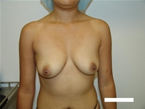 Breast Augmentation Before Photo by Moneer Jaibaji, MD; Coronado, CA - Case 20456