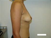 Breast Augmentation Before Photo by Moneer Jaibaji, MD; Coronado, CA - Case 20456