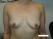 Breast Augmentation Before Photo by Moneer Jaibaji, MD; Coronado, CA - Case 20457