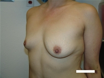 Breast Augmentation Before Photo by Moneer Jaibaji, MD; Coronado, CA - Case 20457