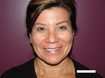 Facelift Before Photo by Moneer Jaibaji, MD; Coronado, CA - Case 20658