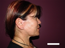 Facelift After Photo by Moneer Jaibaji, MD; Coronado, CA - Case 20658