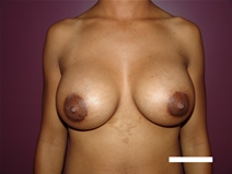 Breast Augmentation After Photo by Moneer Jaibaji, MD; Coronado, CA - Case 20734