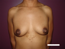 Breast Augmentation Before Photo by Moneer Jaibaji, MD; Coronado, CA - Case 20734