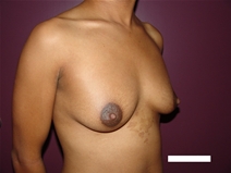 Breast Augmentation Before Photo by Moneer Jaibaji, MD; Coronado, CA - Case 20734