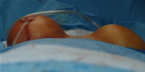 Breast Lift After Photo by Moneer Jaibaji, MD; Coronado, CA - Case 20841