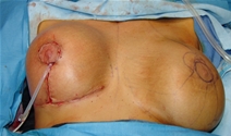 Breast Lift Before Photo by Moneer Jaibaji, MD; Coronado, CA - Case 20841