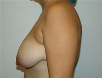 Breast Lift Before Photo by Moneer Jaibaji, MD; Coronado, CA - Case 20843