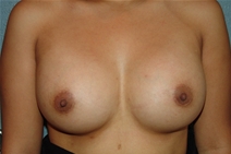Breast Augmentation After Photo by Moneer Jaibaji, MD; Coronado, CA - Case 20844