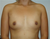 Breast Augmentation Before Photo by Moneer Jaibaji, MD; Coronado, CA - Case 20844
