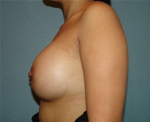 Breast Augmentation After Photo by Moneer Jaibaji, MD; Coronado, CA - Case 20844