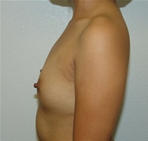 Breast Augmentation Before Photo by Moneer Jaibaji, MD; Coronado, CA - Case 20844