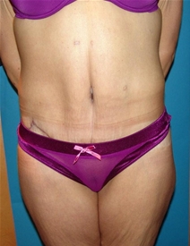 Body Contouring After Photo by Moneer Jaibaji, MD; Coronado, CA - Case 20847