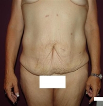 Body Contouring Before Photo by Moneer Jaibaji, MD; Coronado, CA - Case 20847