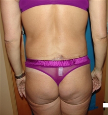 Body Contouring After Photo by Moneer Jaibaji, MD; Coronado, CA - Case 20847