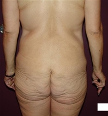 Body Contouring Before Photo by Moneer Jaibaji, MD; Coronado, CA - Case 20847