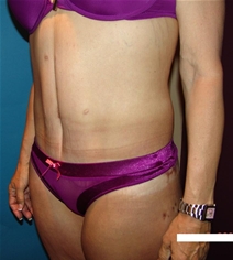 Body Contouring After Photo by Moneer Jaibaji, MD; Coronado, CA - Case 20847