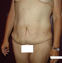 Body Contouring Before Photo by Moneer Jaibaji, MD; Coronado, CA - Case 20847