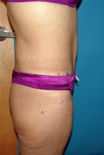 Body Contouring After Photo by Moneer Jaibaji, MD; Coronado, CA - Case 20847