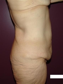 Body Contouring Before Photo by Moneer Jaibaji, MD; Coronado, CA - Case 20847