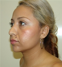 Liposuction After Photo by Moneer Jaibaji, MD; Coronado, CA - Case 20853