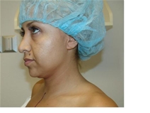 Liposuction Before Photo by Moneer Jaibaji, MD; Coronado, CA - Case 20853