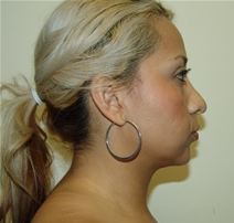 Liposuction After Photo by Moneer Jaibaji, MD; Coronado, CA - Case 20853