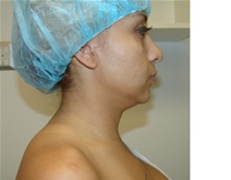 Liposuction Before Photo by Moneer Jaibaji, MD; Coronado, CA - Case 20853