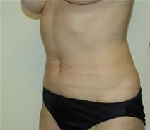 Liposuction After Photo by Moneer Jaibaji, MD; Coronado, CA - Case 20854