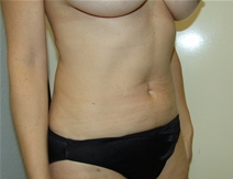 Liposuction After Photo by Moneer Jaibaji, MD; Coronado, CA - Case 20854