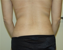 Liposuction After Photo by Moneer Jaibaji, MD; Coronado, CA - Case 20854