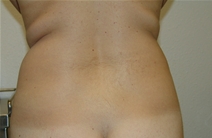 Liposuction Before Photo by Moneer Jaibaji, MD; Coronado, CA - Case 20854