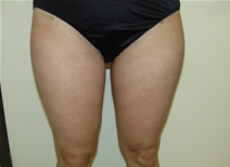 Liposuction After Photo by Moneer Jaibaji, MD; Coronado, CA - Case 20855