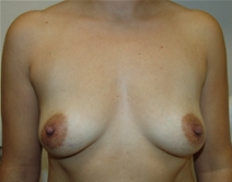 Breast Augmentation Before Photo by Moneer Jaibaji, MD; Coronado, CA - Case 20902