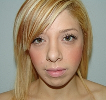 Rhinoplasty After Photo by Moneer Jaibaji, MD; Coronado, CA - Case 21130