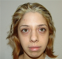 Rhinoplasty Before Photo by Moneer Jaibaji, MD; Coronado, CA - Case 21130