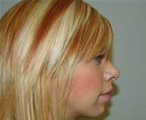 Rhinoplasty After Photo by Moneer Jaibaji, MD; Coronado, CA - Case 21130