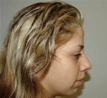 Rhinoplasty Before Photo by Moneer Jaibaji, MD; Coronado, CA - Case 21130