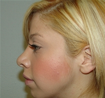 Rhinoplasty After Photo by Moneer Jaibaji, MD; Coronado, CA - Case 21130
