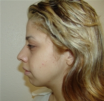 Rhinoplasty Before Photo by Moneer Jaibaji, MD; Coronado, CA - Case 21130