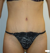 Tummy Tuck After Photo by Moneer Jaibaji, MD; Coronado, CA - Case 21168