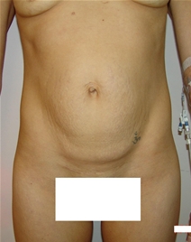 Tummy Tuck Before Photo by Moneer Jaibaji, MD; Coronado, CA - Case 21168