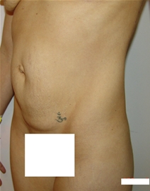Tummy Tuck Before Photo by Moneer Jaibaji, MD; Coronado, CA - Case 21168