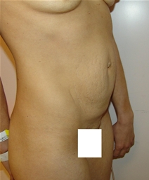 Tummy Tuck Before Photo by Moneer Jaibaji, MD; Coronado, CA - Case 21168